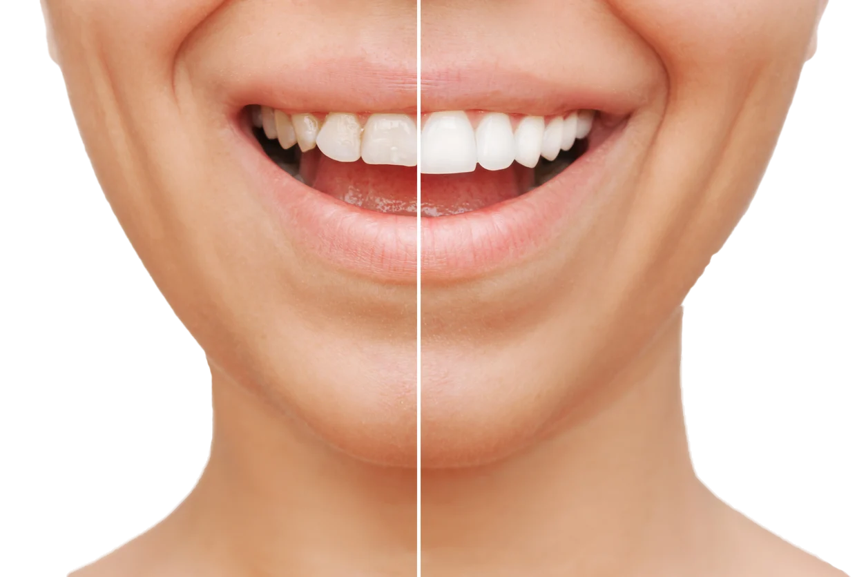 Smile makeover image from Dr. Jack Ohanesian DDS